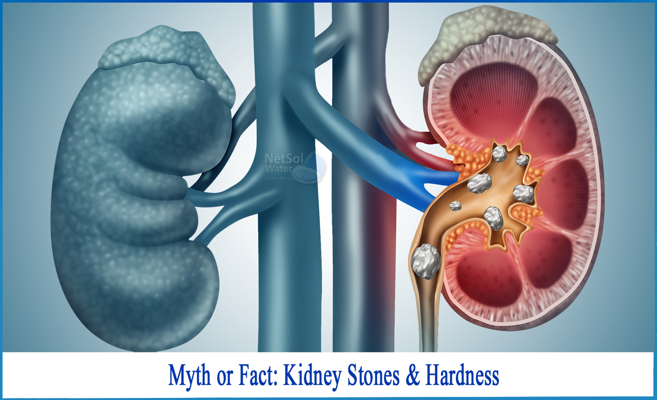 does hard water cause kidney problems, TDSlevel for kidney patients, does RO water cause kidney stones